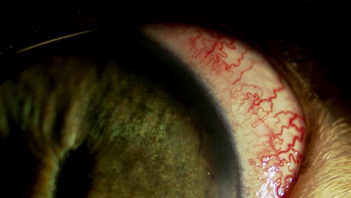 三毛猫10歳　健康診断で来院　左眼上強膜充血で緑内障を比較的早期に発見